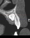 Wurzelresorption