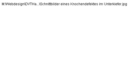 Schnittbilder eines Knochendefektes im Unterkiefer