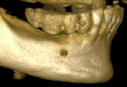 Unterkieferknochen dvt