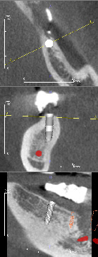 3D Implantatplanung 